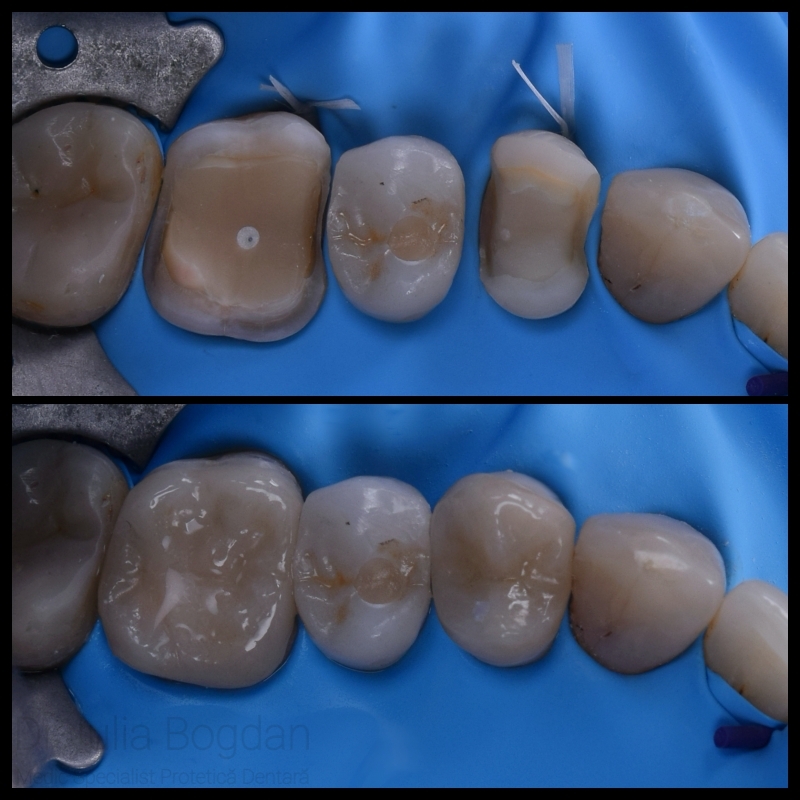 Overlay ceramic
