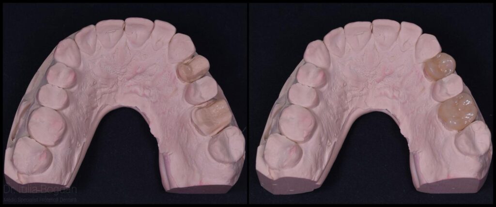 dentist cluj Overlay ceramic