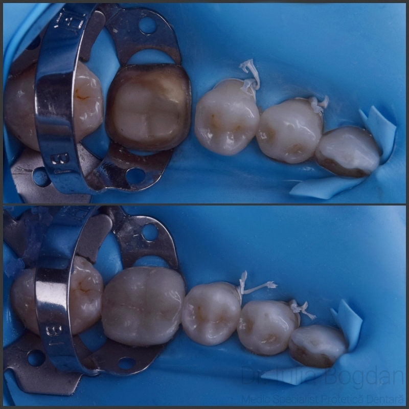 Restaurare protetica fixa din zirconiu monolit